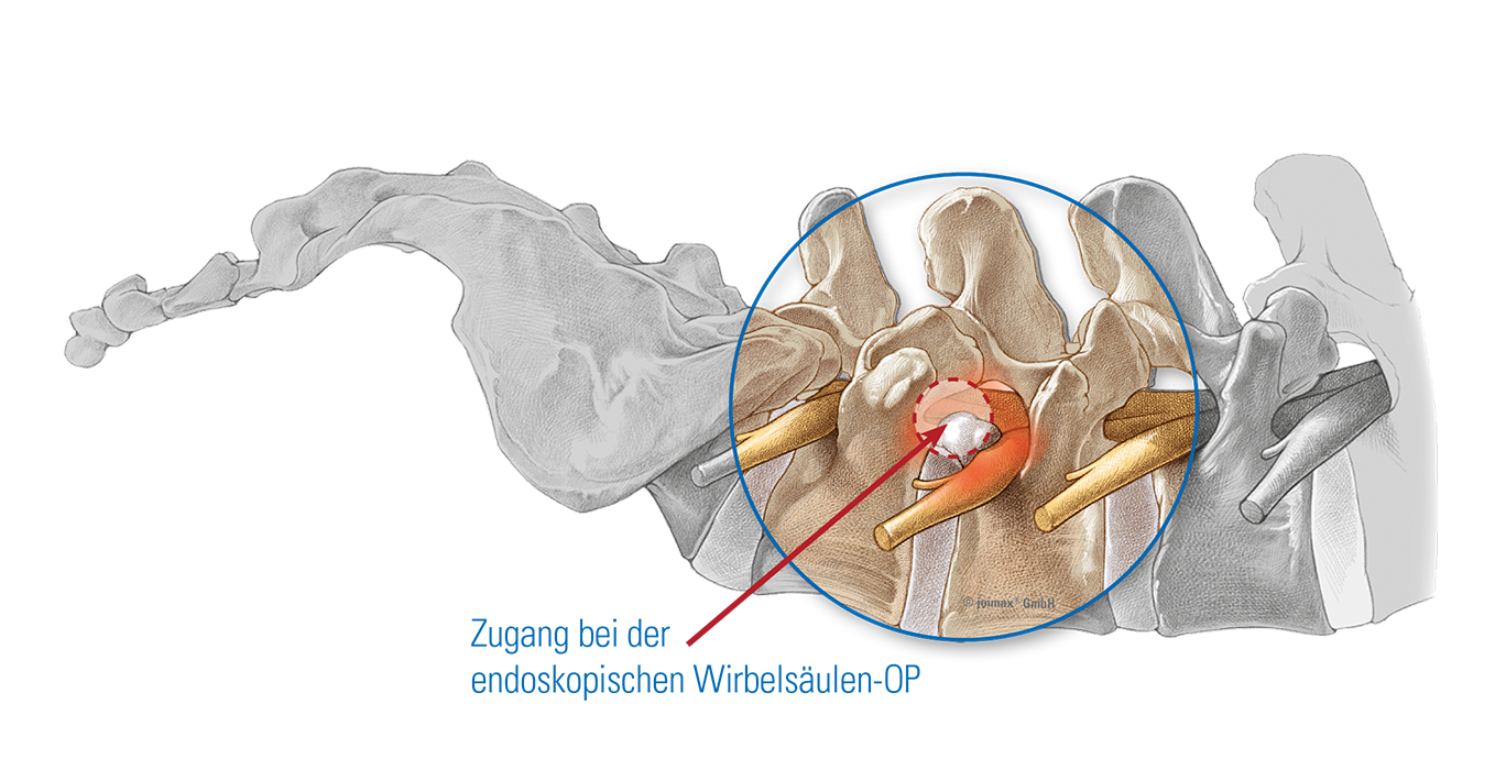 Illustration Zugang Endoskopische OP